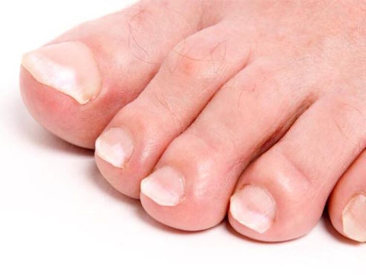 nail fungus and its treatment