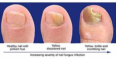 The manifestation of nail fungi