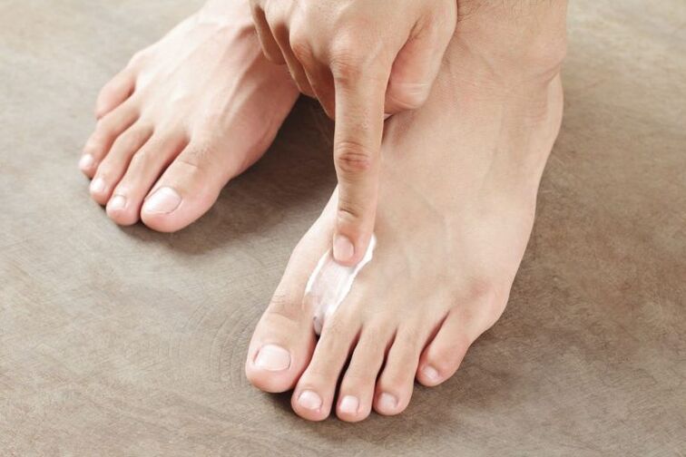 Application of antifungal cream to the skin of the foot