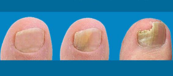 Stages of nail fungi
