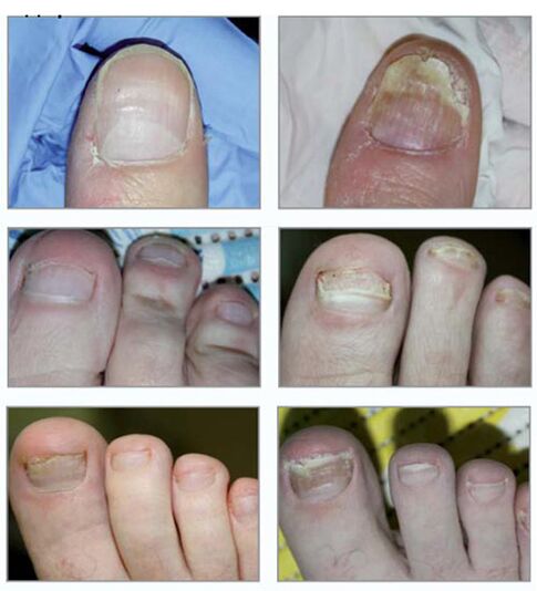 Types of nail fungi