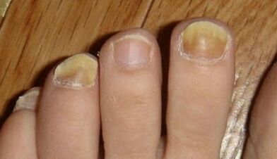 Reasons for the image of the mushroom in the nail