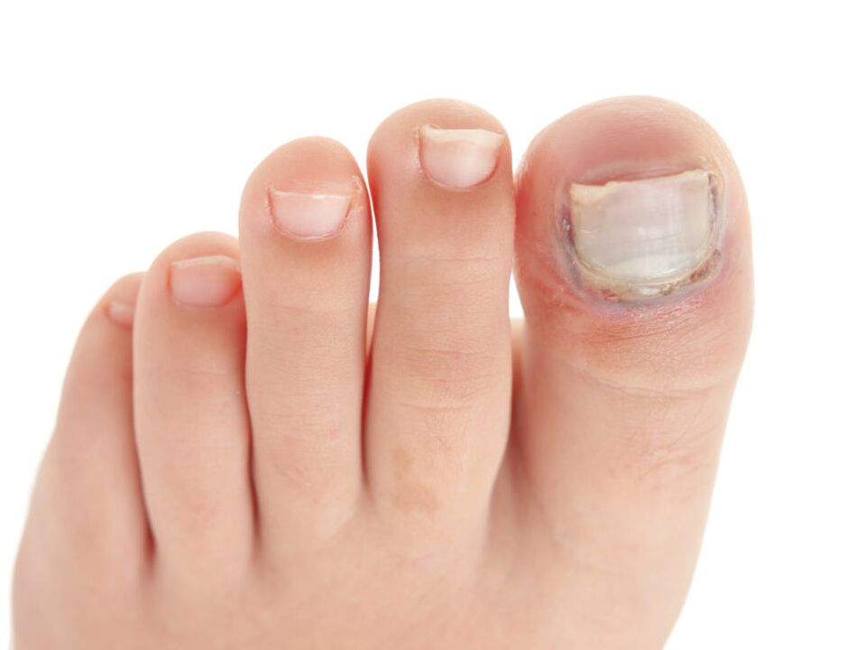 fungal nail plate damage