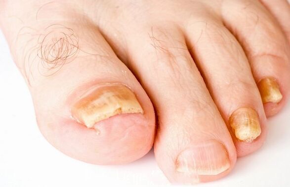 Forms of nail fungi