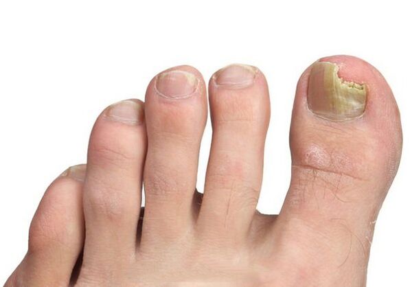Reasons for nail fungi
