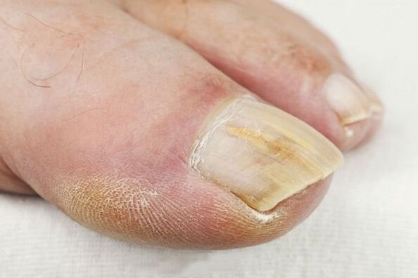 Results of cousing lesions