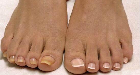 Normal nails and nails mushrooms