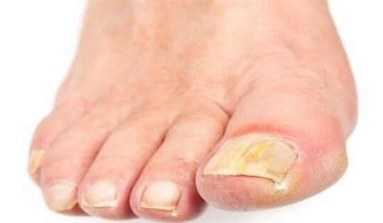 Wrapping nails due to mungal infection