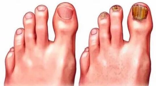 healthy nails and nails affected by mushrooms
