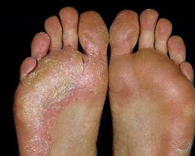 fungal foot damage