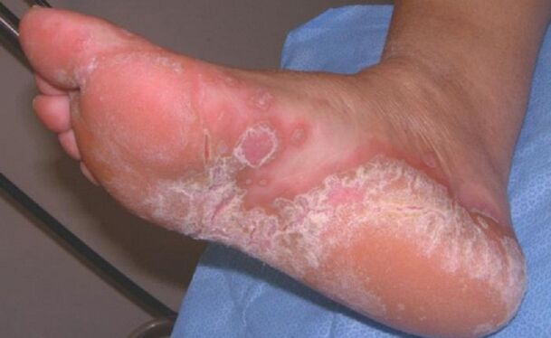 symptoms of foot fungus