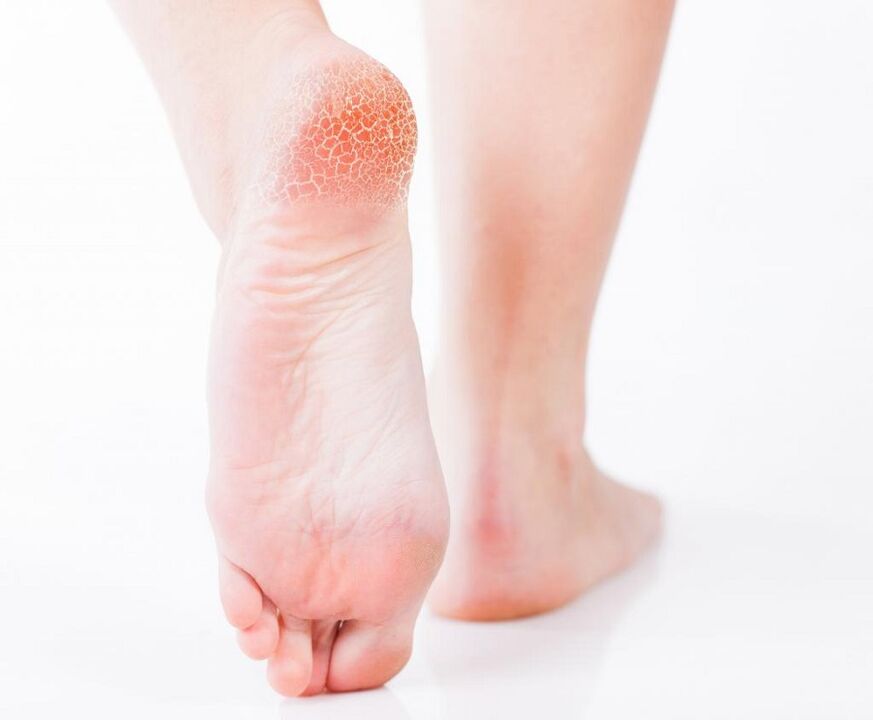fungal infection on foot