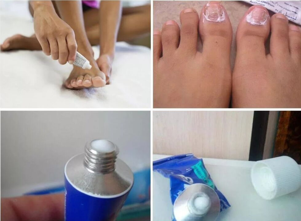 medicine for nail fungus