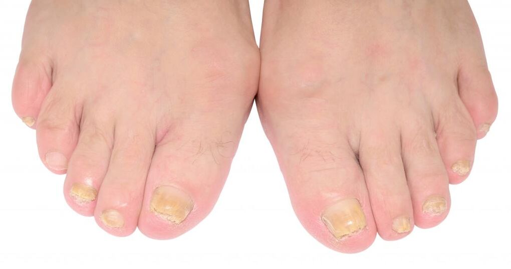 signs of nail fungus