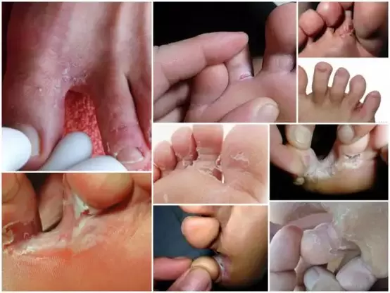 signs of fungus between the toes photo 2