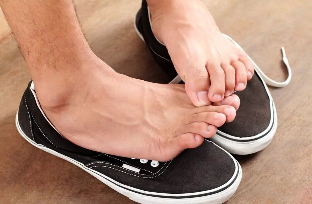 itchy feet due to fungus between the toes