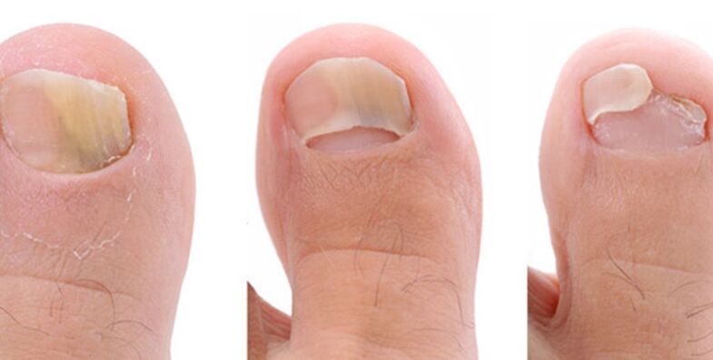 photo of nail fungus