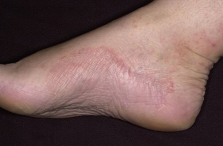 Fungal infection of the foot