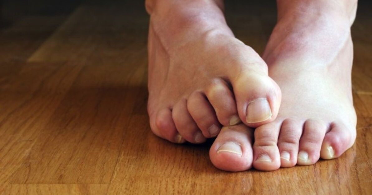 signs of fungus between the toes